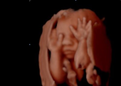 A sonogram of a baby with his hands on his eyes