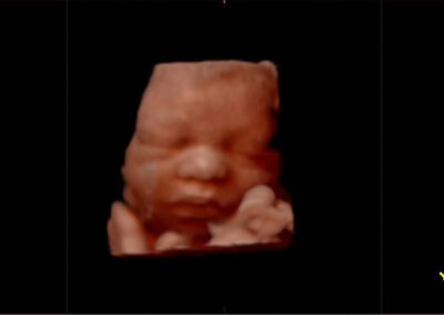 A sonogram of a babys face inside the womb